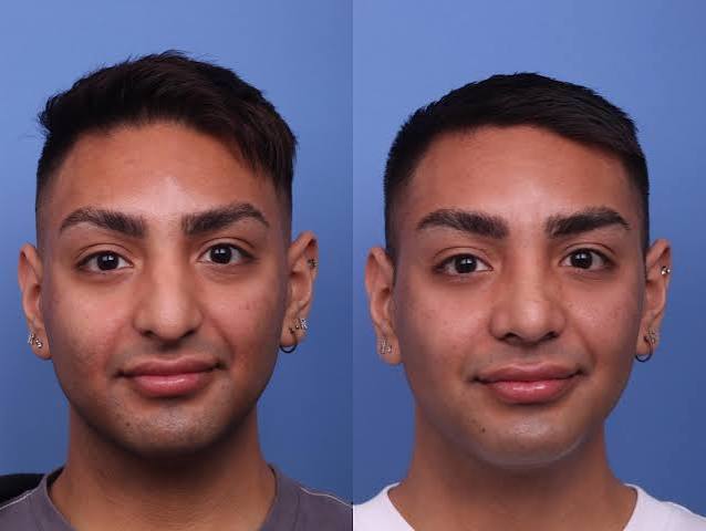 Rhinoplasty